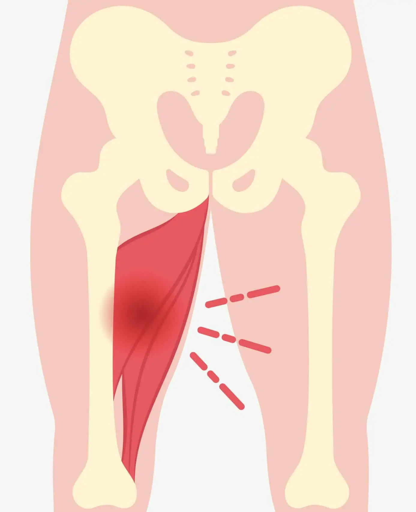 seneirritation