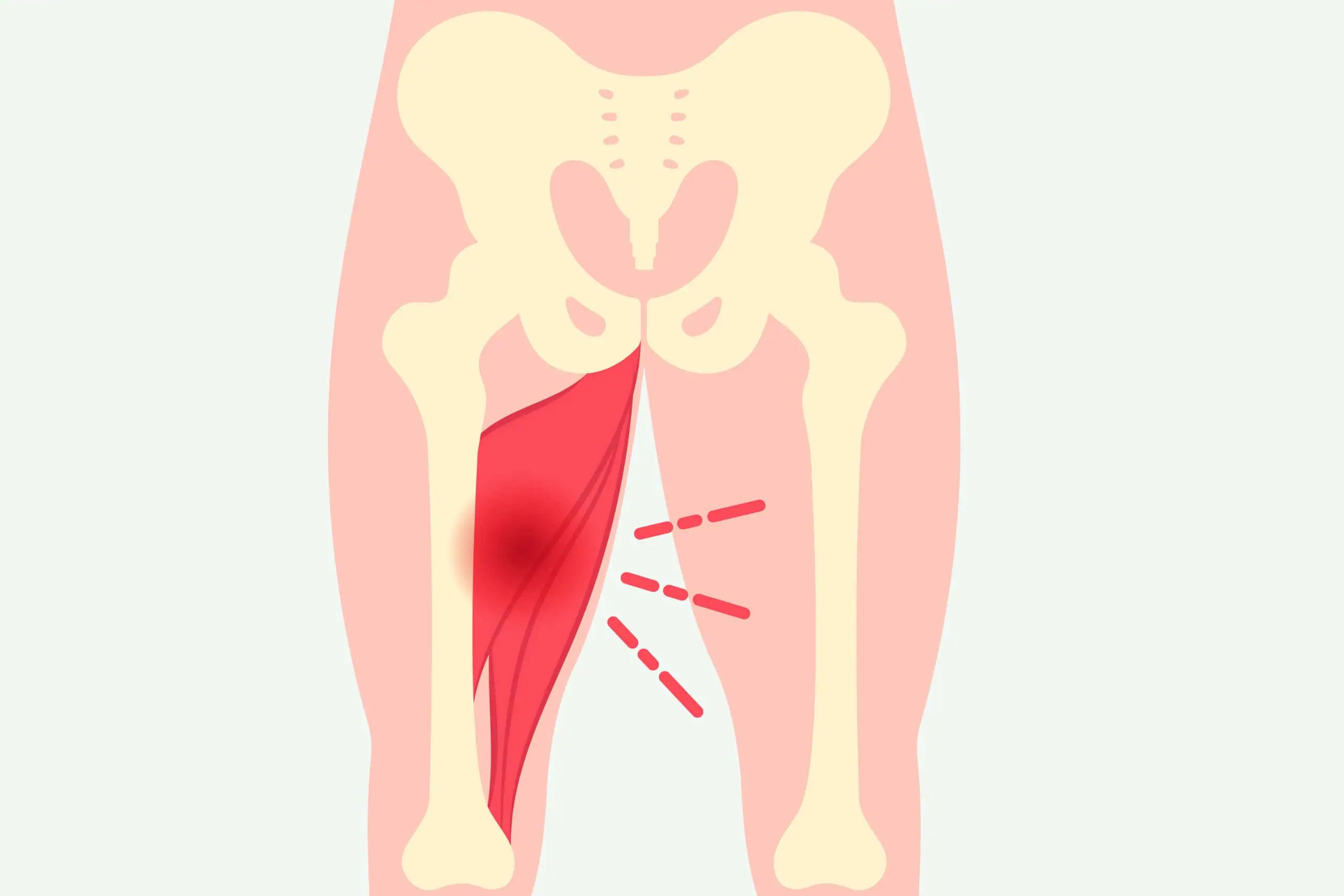 seneirritation