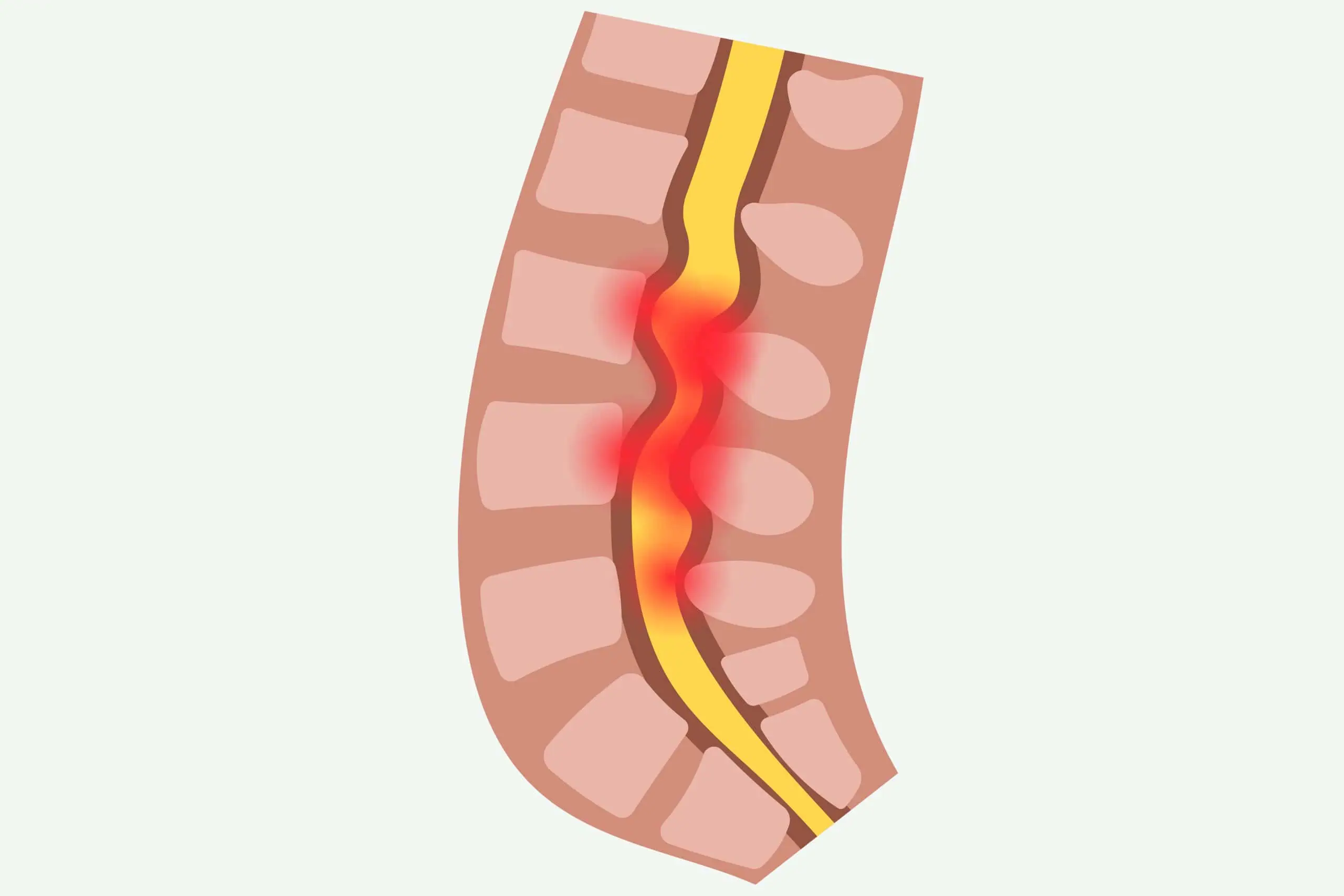 rygsmerter: Spinalstenose