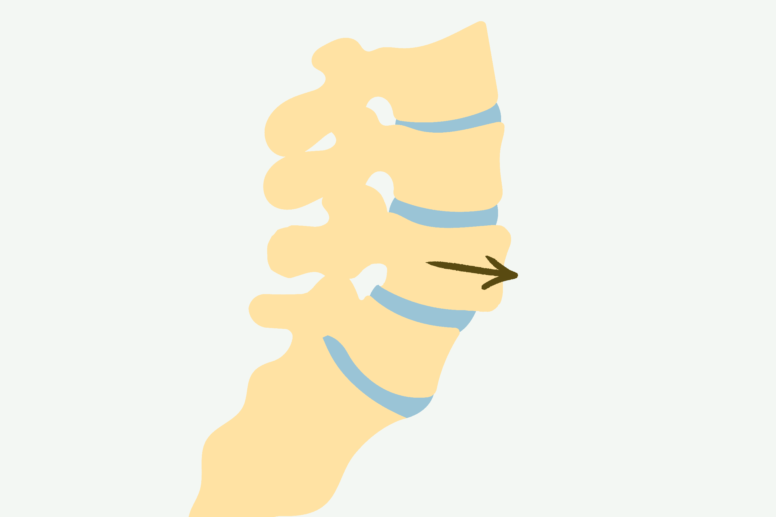 rygsmerter: spondylolistese