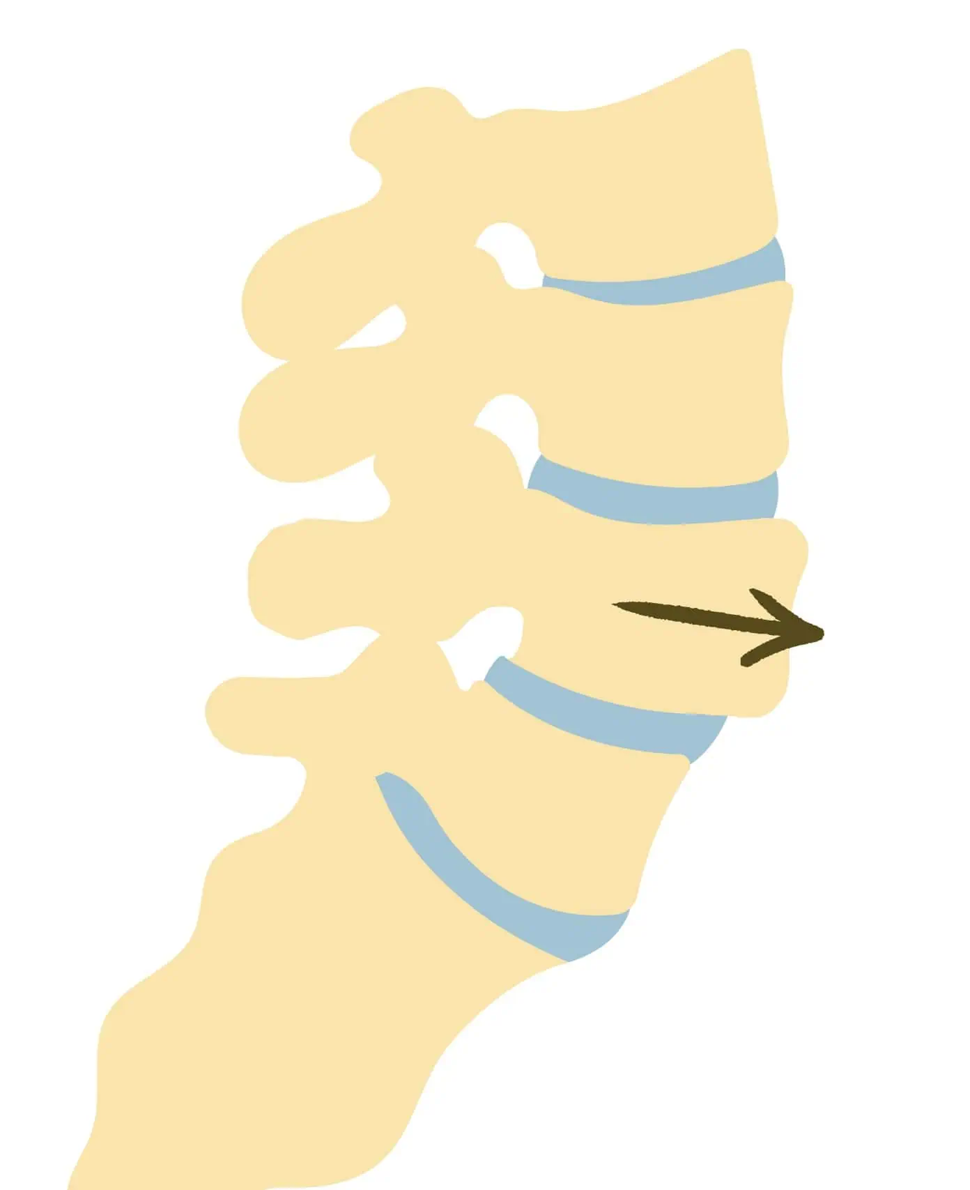 rygsmerter: spondylolistese