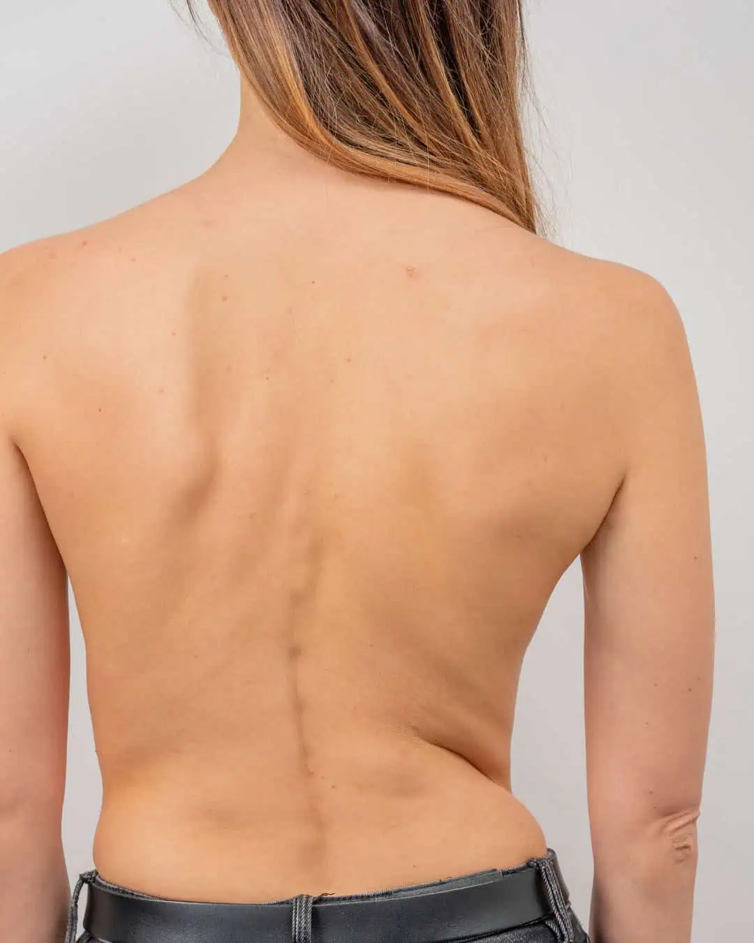 behandling af skoliose hos FysioHuset i Skanderborg