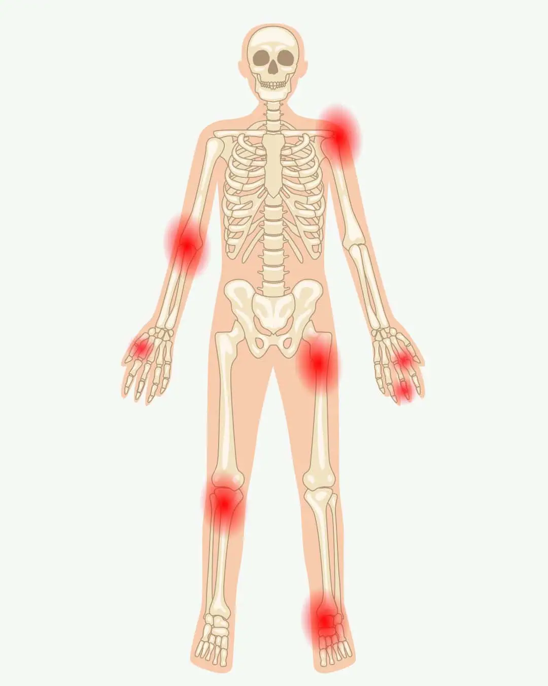 Rheumatoid arthritis, kronisk leddegigt - kronisk lidelse