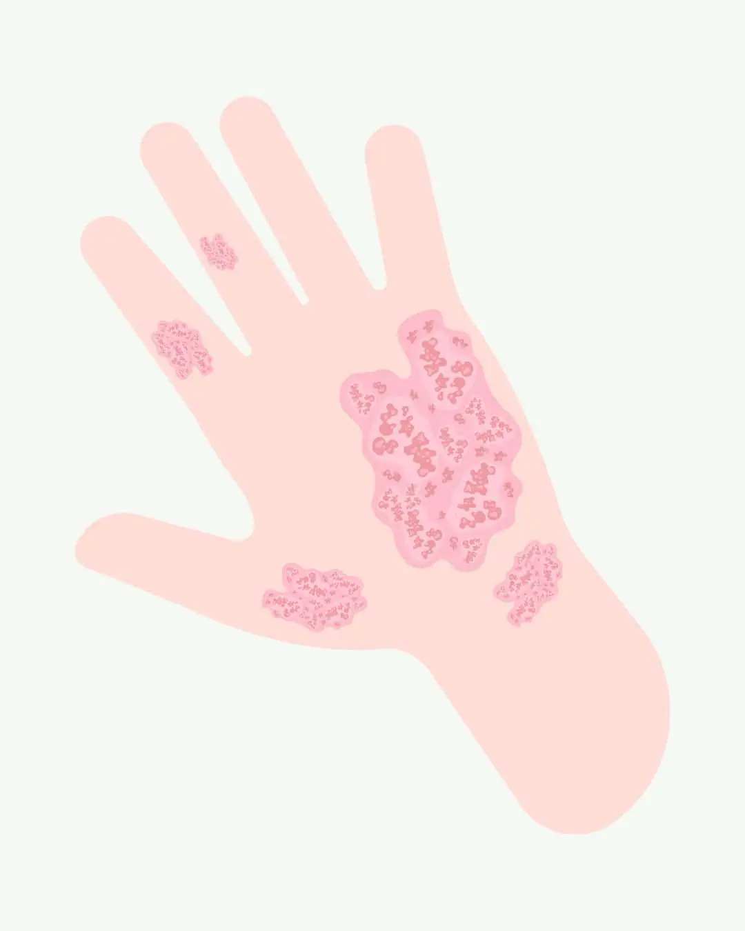 Psoriasis arthtritis (psoriasisgigt) - kronisk lidelse